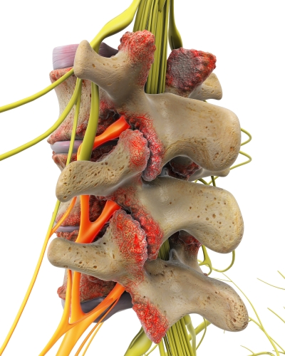 PMA - Facet Joint Syndrome