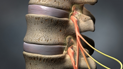 PMA - Spinal Stenosis