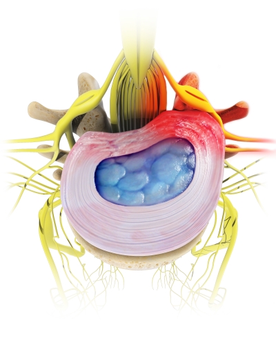 PMA - Herniated cervical or lumbar disc