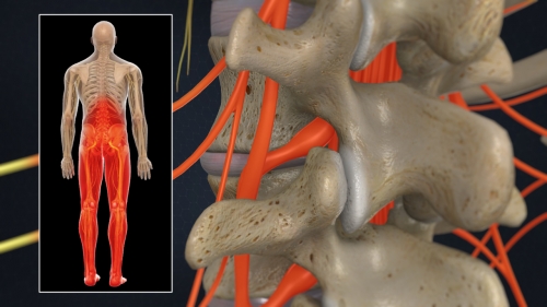 PMA - Lumbar Radiculopathy (Sciatica)