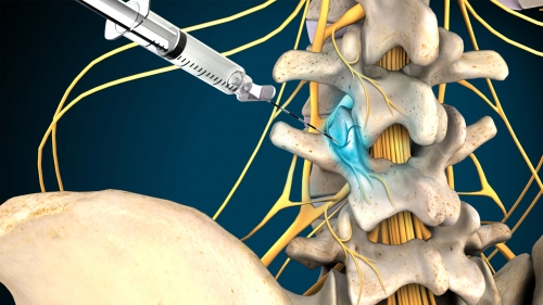 PMA - Pain Blocks