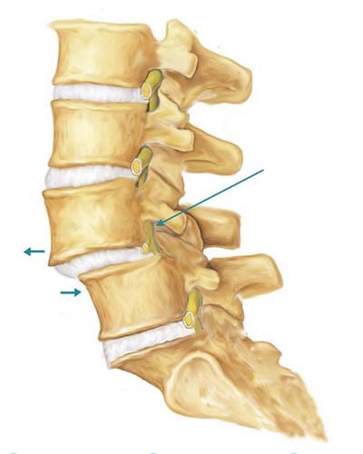 PMA - Spondylolisthesis